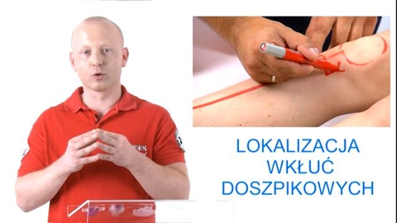 Użycie wkłuć doszpikowych